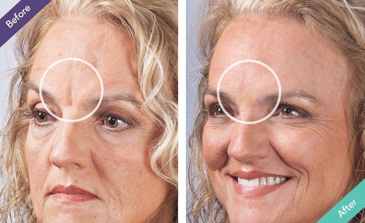 Smart-Collagen-before-after-pictures