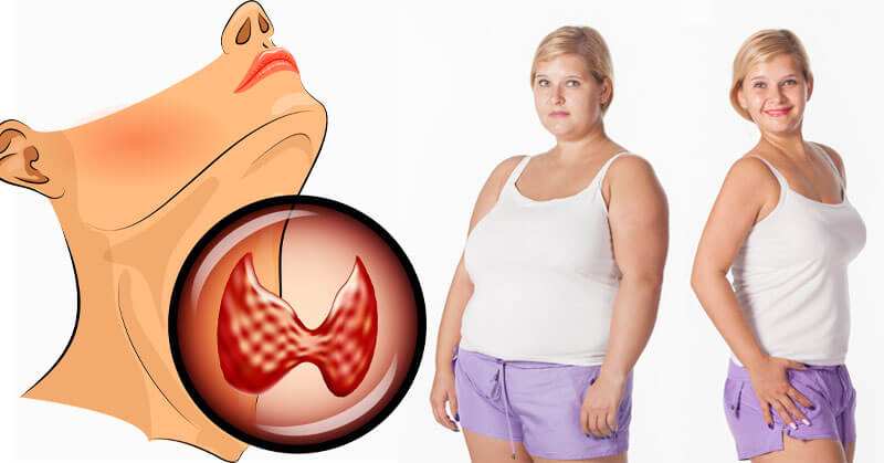 Hypothyroidism And Weight Gain