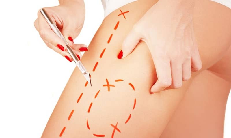 What Helps Get Rid of Cellulite